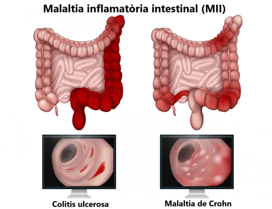 Crohn_colitis.jpg